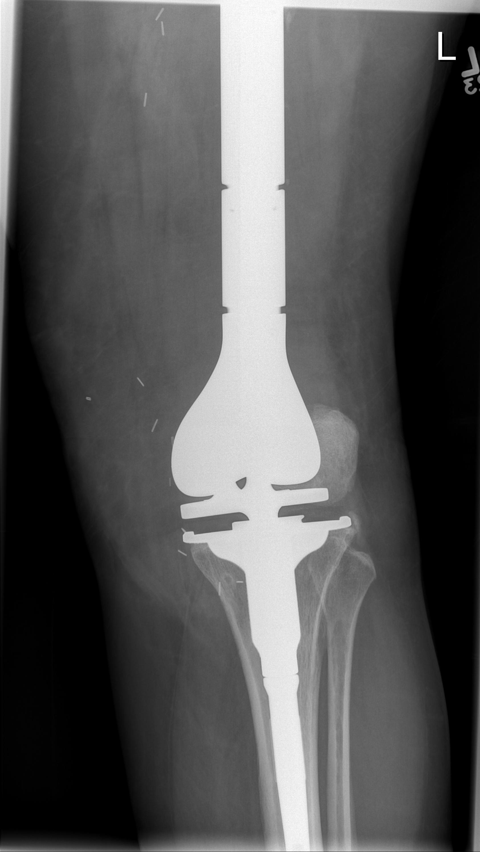 Osteosarcoma Distal Femur Tumour Prosthesis